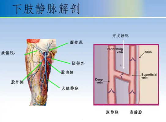 静脉曲张早治疗